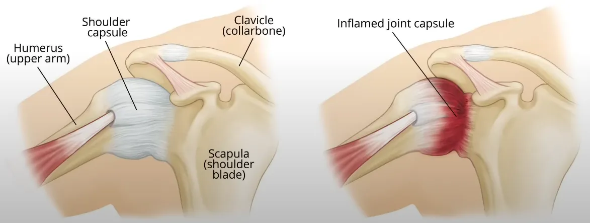 Medical illustration of inflamed and thickened joint capsule in frozen shoulder