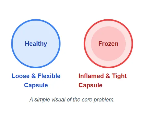 Illustration showing inflamed and tightened shoulder capsule